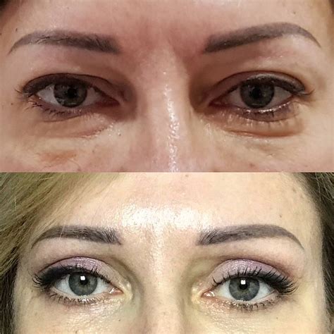 blefaroplastika-v-almetevske-4