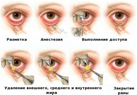 blefaroplastika-v-chelyabinske-2