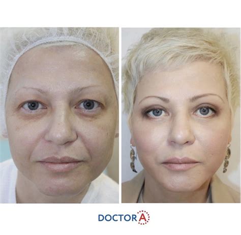 blefaroplastika-v-kaluge-2