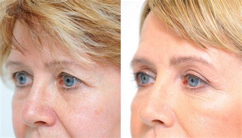 blefaroplastika-v-nahodke-2