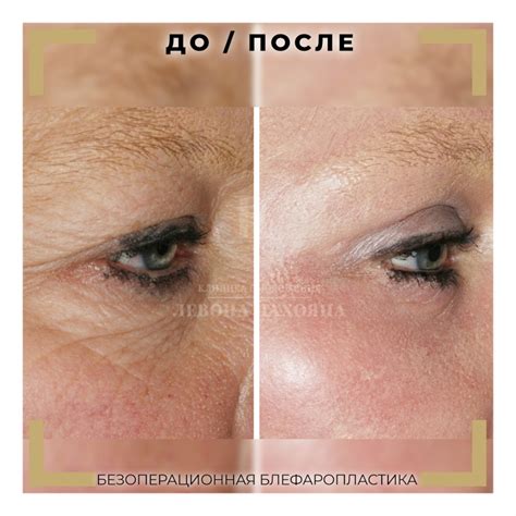 blefaroplastika-v-nefteyuganske
