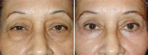 blefaroplastika-v-podolske-2