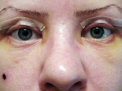 kak-uhazhivat-za-vekami-posle-blefaroplastiki-zazhivlenie-i-vosstanovlenie-sovety-vrachey