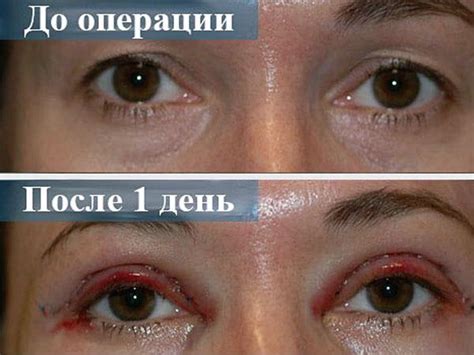 sinyaki-posle-blefaroplastiki-ubrat-skolko-dney-sinyaki-kak-izbavitsya