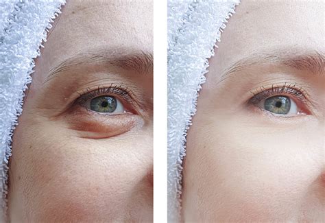 blefaroplastika-doma-kak-vypolnit